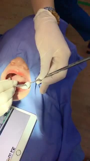 Phục hình răng sứ trên Implant "đẹp chuẩn" tại Kangam