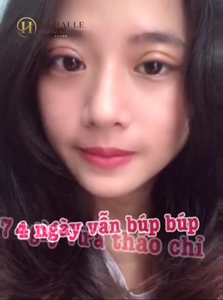 Cứu tinh mắt một mí CHỈ 1 LẦN DUY NHẤT  Làm 1 lần, đẹp trọn đời Thẩm mỹ mắt tặng ngay 7.5 Triệu.