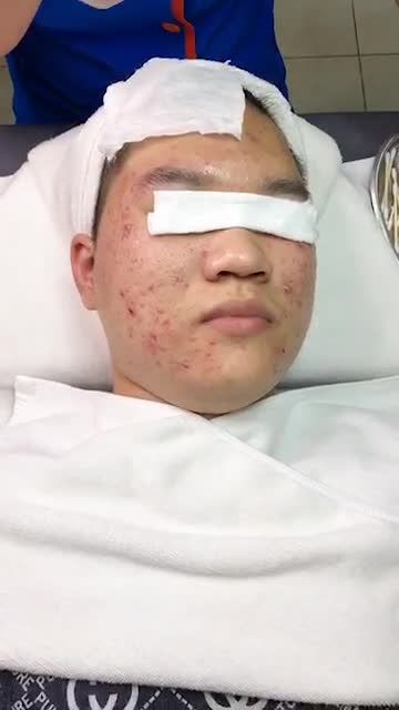Hành trình quét sạch Mụn - đào thải nhân mụn cho khách hàng nam tại Kangnam