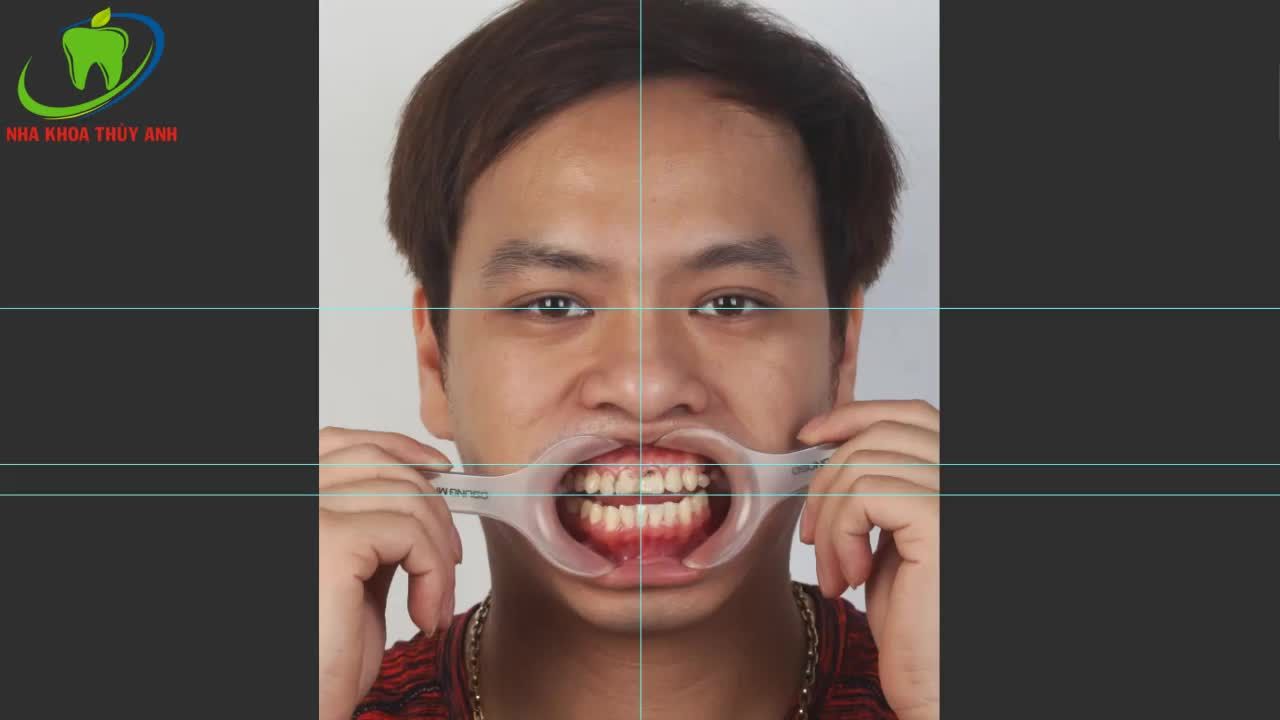 BỌC SỨ BIẾT TRƯỚC KẾT QUẢ ĐỪNG LO HÃY ĐẾN NHA KHOA THÙY ANH ĐỂ SỞ HỮU NỤ CƯỜI HẰNG MONG ĐỢI
