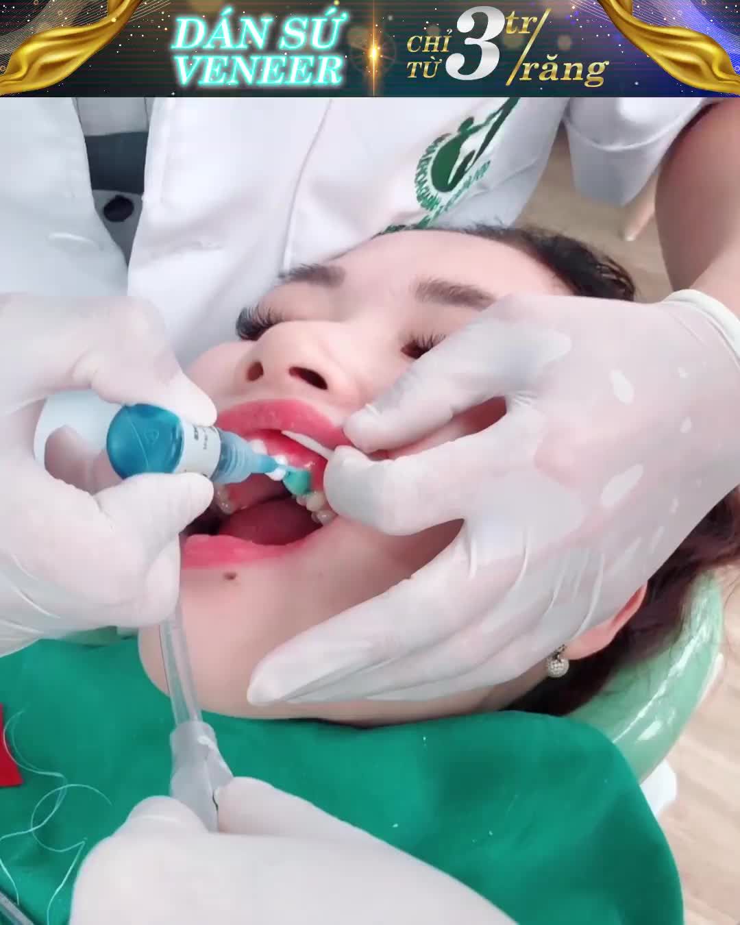DÁN SỨ VENEER CHỈ TỪ 3TR/RĂNG – ĐĂNG KÝ NGAY