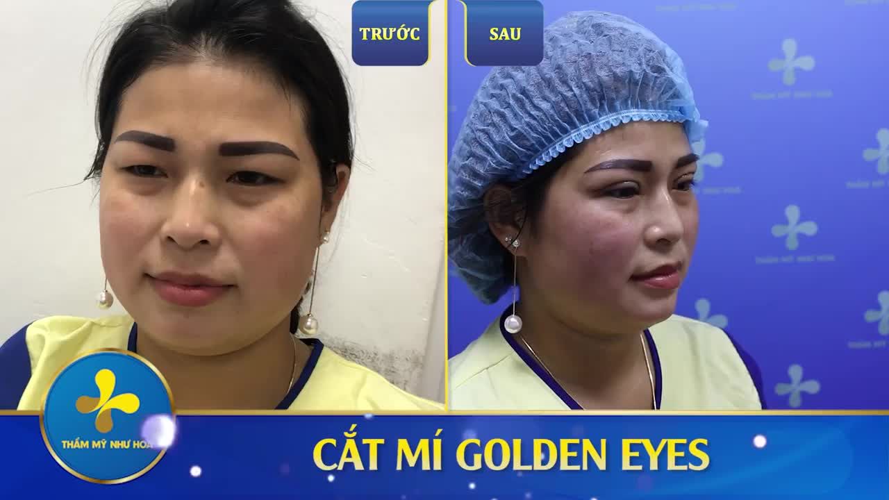 Mắt không rõ mí  Mí sụp, mí ẩn  Da chùng  30 phút cắt mí GoldenEyes; khoảng 8 - 10 ngày cắt chỉ