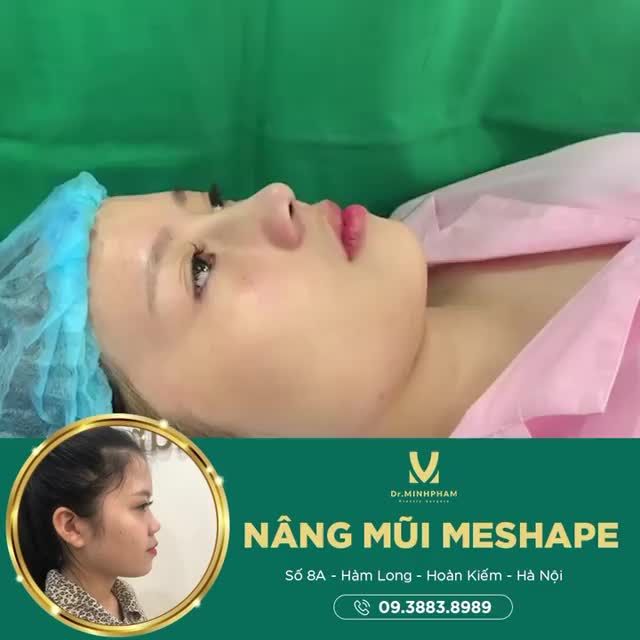 NÂNG MŨI MESHAPE - BÍ MẬT CỦA CHIẾC MŨI ĐẸP HOÀN HẢO