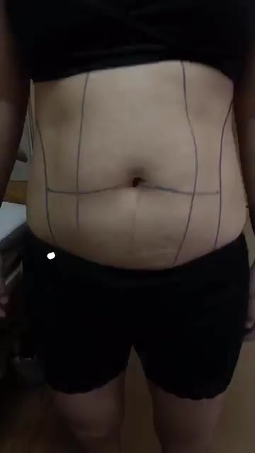 Phân tích trước hút mỡ số 658
