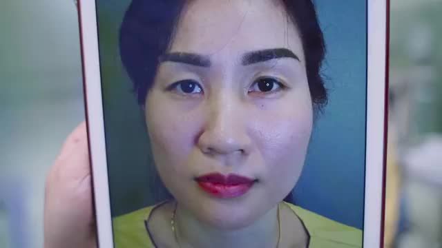 Đôi mắt một mí, thiếu mỡ khiến gương mặt chị khách hàng lúc nào cũng mệt mỏi, u sầu, thiếu sức sống.