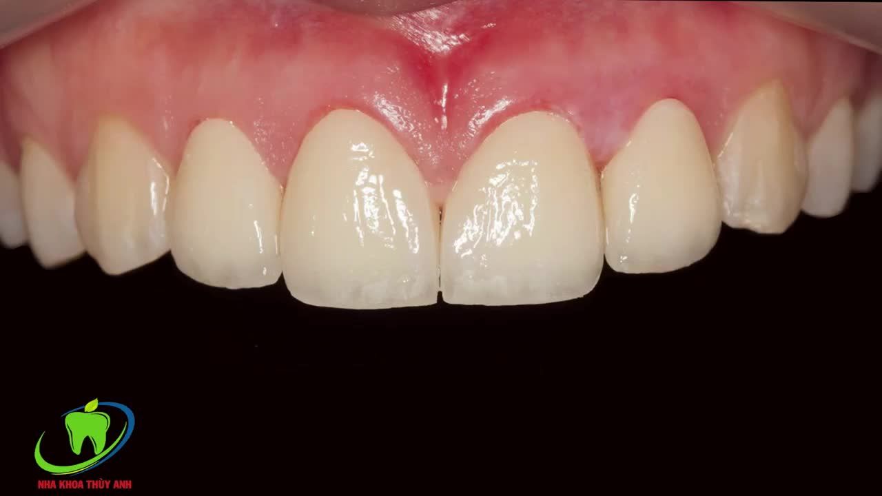 BỌC RĂNG SỨ HOÀN THIỆN NỤ CƯỜI TỰ TIN TỎA SÁNG