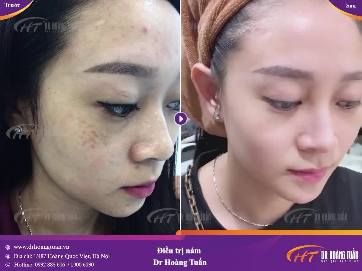 Cận cảnh làn da của một khách hàng TRỊ NÁM THÀNH CÔNG - KHÔNG TÁI PHÁT tại Dr Hoàng Tuấn đây ạ!