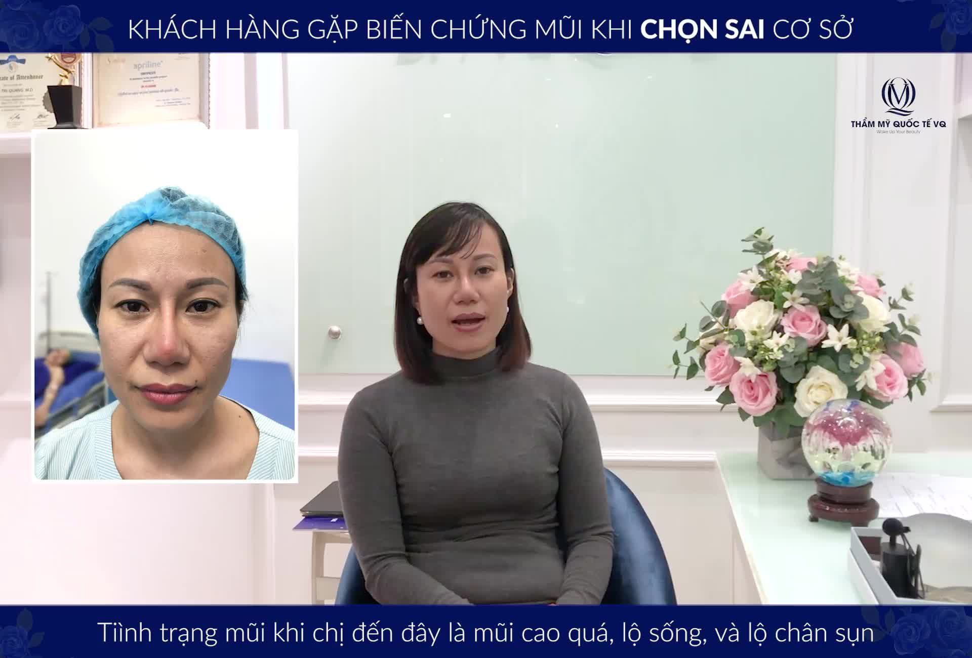 Hành trình tìm lại dáng mũi như ý sau khi nâng mũi hỏng tại cơ sở không uy tín cách đây 7 tháng