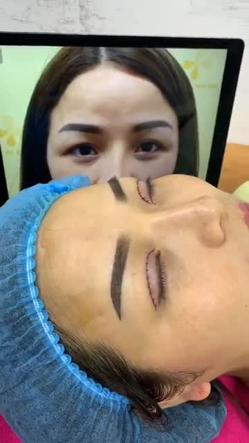 KH cắt mí sau 30 phút Cùng chiêm ngưỡng thành quả nào !