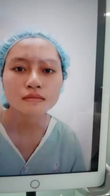 NÂNG MŨI CẤU TRÚC SỬA LẠI - MŨI ĐẸP NGAY SAU 90P