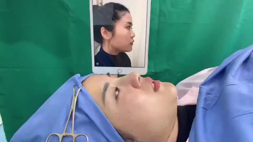 NÂNG MŨI MESHAPE CÙNG DRMINHPHAM