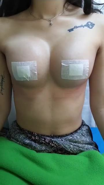 Nâng ngực nội soi chân không