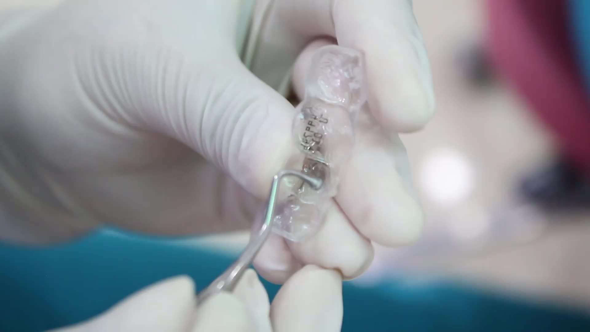 Case lắp máng niềng trong suốt Invisalign cho bệnh nhân L. H. L - 36 tuổi ở Sóc Sơn