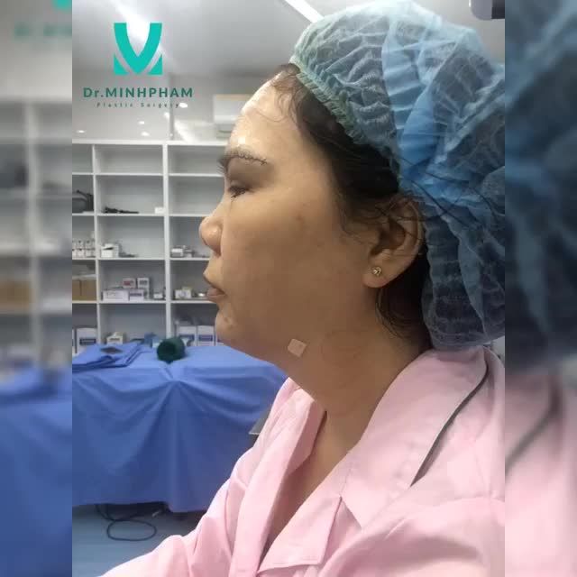 CÔNG NGHỆ CẮT MÍ TIÊN TIẾN SILKPLUS