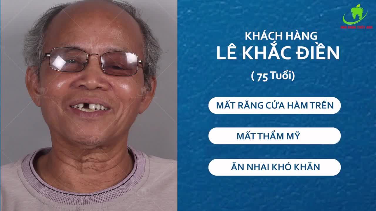 IMPLANT - TRỒNG RĂNG GIẢ NHƯ RĂNG THẬT