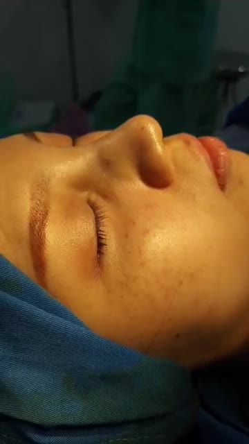 Nâng mũi bán cấu trúc 2 lớp cho em gái ở Đồng Nai.