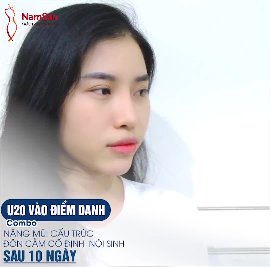 Những ca Combo NÂNG MŨI + ĐỘN CẰM tại NamSan vẫn chưa bao giờ hạ nhiệt!