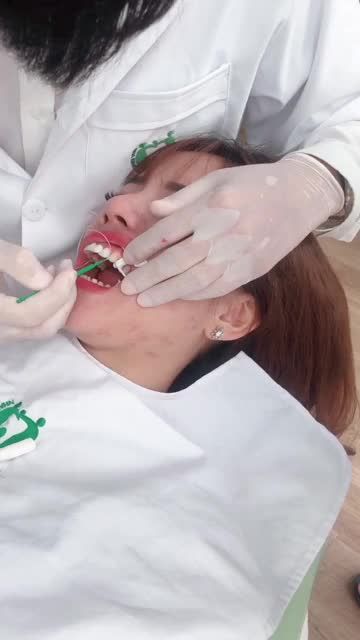 THẾ NÀO LÀ DÁN SỨ VENEER ĐÚNG NGHĨA