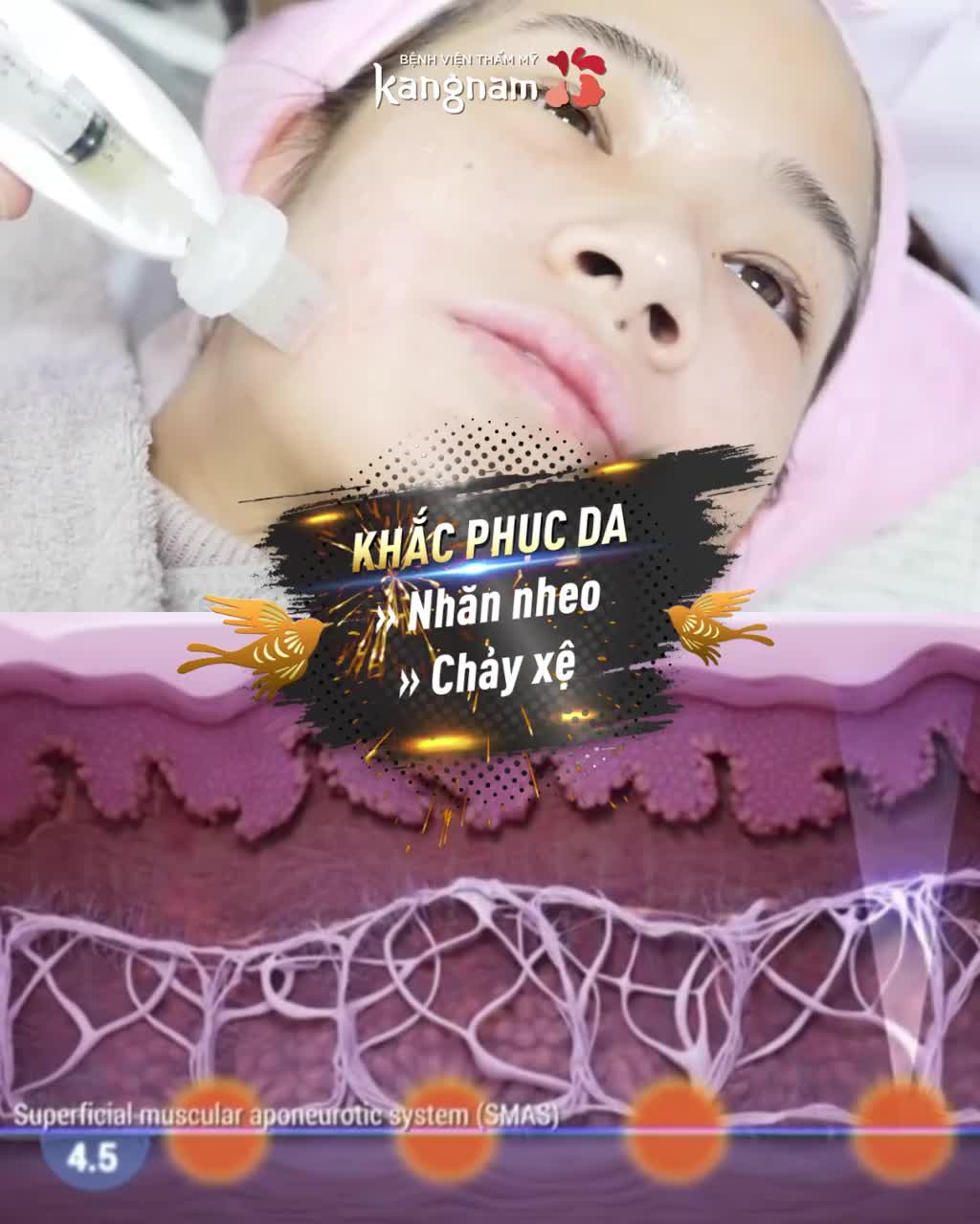 Xóa nhăn nâng cơ - Đẹp ngay sau 1 lần - Chỉ từ 1 triệu