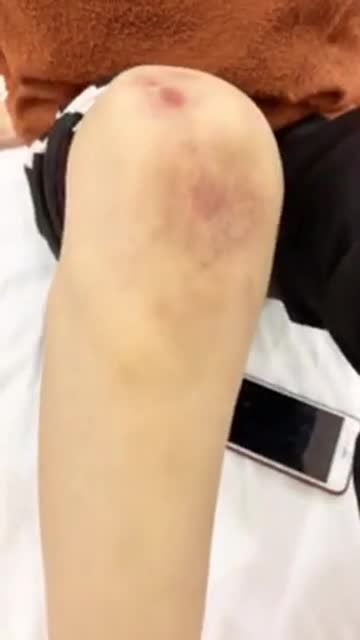 Điều trị sẹo lồi xấu xí hiệu quả lên đến 90%