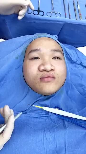 Quy trình đo vẽ thiết kể phẫu thuật cắt mí plasma tại bvtm Kangnam