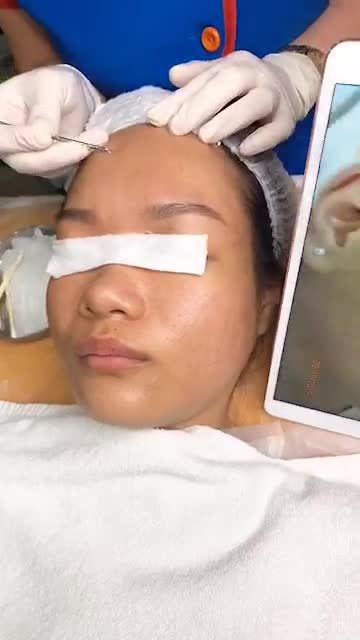 Kết quả "BẤT NGỜ" với điều trị mụn Nano Skin tại Kangnam