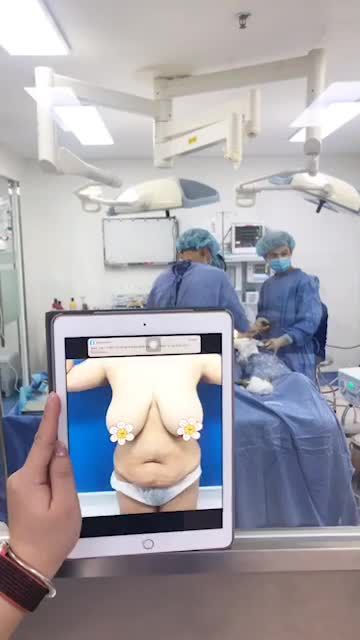 Một ca đại phẫu thứ 2 trong ngày Bác sĩ đang Thực hiện Ca ngực To khủng phì đại cấp độ 3 và Lipo bụng tạo hình