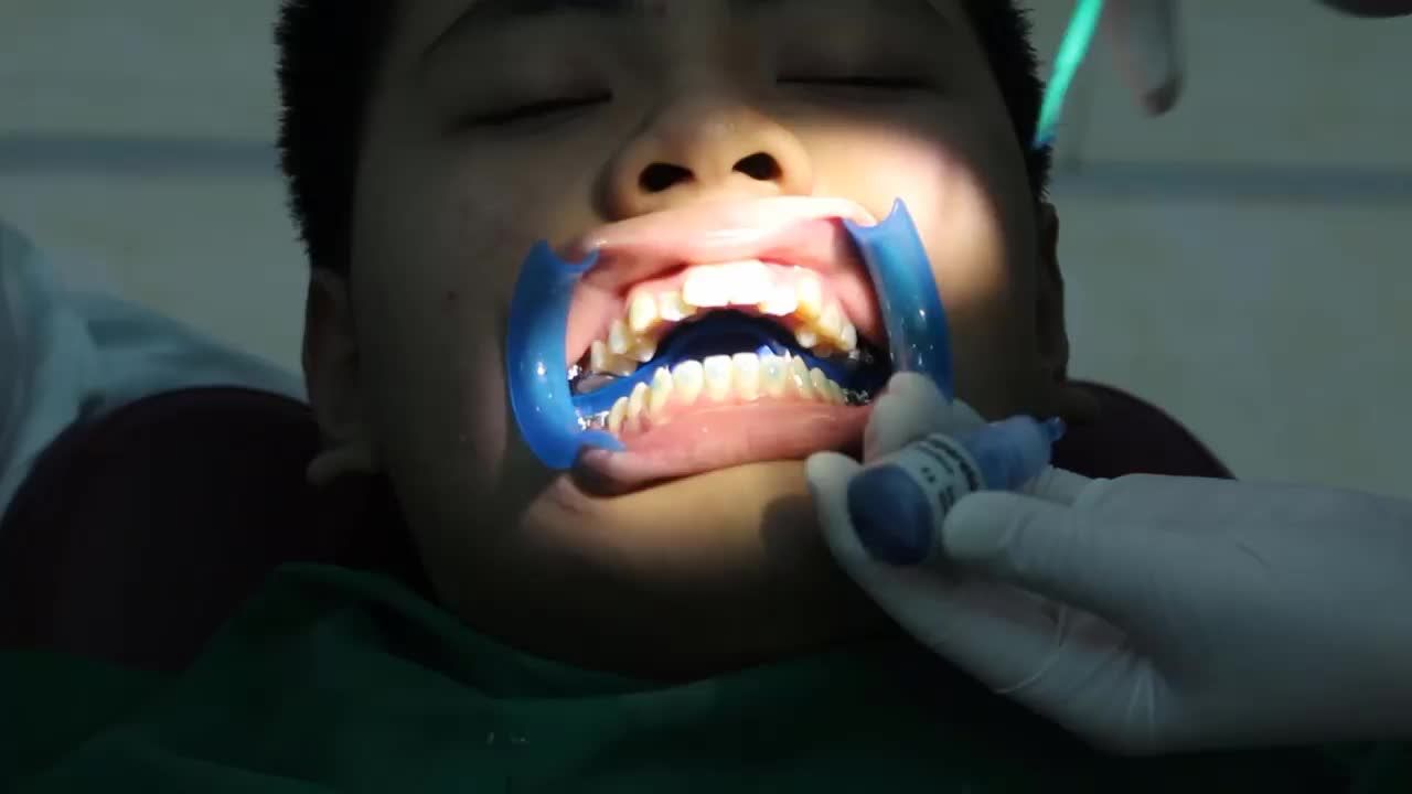 Case gắn mắc cài kim loại cho bệnh nhân T. M. T - 13 tuổi ở Mỹ Đình - Hà Nội