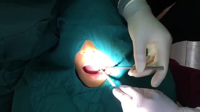 Cấy ghép chân răng nhân tạo Implant cho anh Nghĩa Anh tại Nha Khoa Thùy Anh.