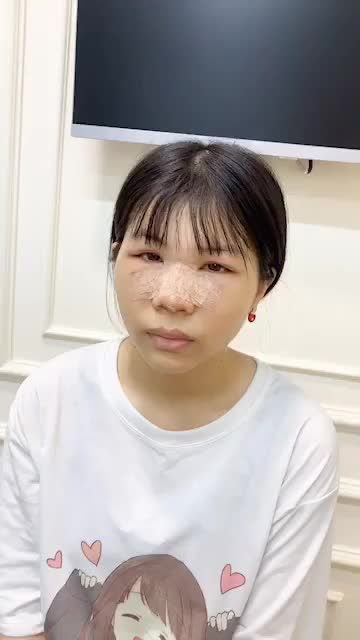 MŨI CẤU TRÚC LÓT SỤN ĐA LỚP TẠI NAMSAN SAU 2 NGÀY NHƯ THẾ NÀO?