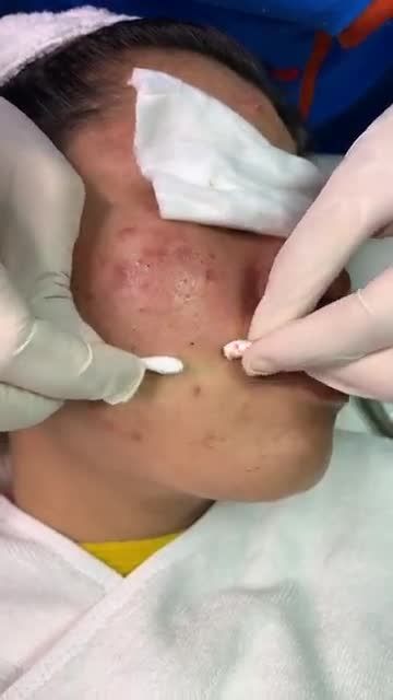 Quét sạch các loại mụn sau liệu trình điều trị mụn tại Bvtm Kangnam