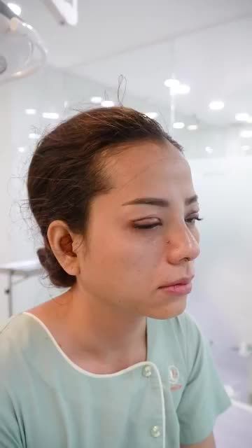 COMBO NÂNG MŨI + CẮT MÍ VỪA THỰC HIỆN XONG