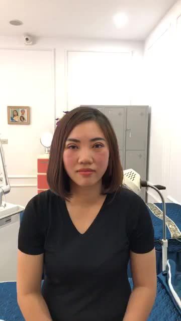Cùng gặp gỡ chị khách hàng cắt mí baby eyes 6d sau 6 ngày