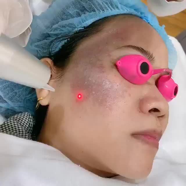 Cận cảnh điều trị bớt ota bằng công nghệ laser độc quyền tại Đông Á, đáp ứng 3 KHÔNG