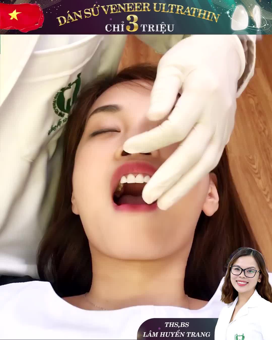 DÁN SỨ VENEER – TÂN TRANG NỤ CƯỜI CỦA BẠN Bảo hành lên đến trọn đời