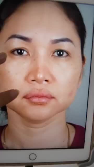 DÁNG MŨI CẤU TRÚC SAU 10 NGÀY ĐƯỢC DR.HOẠT SỬA LẠI