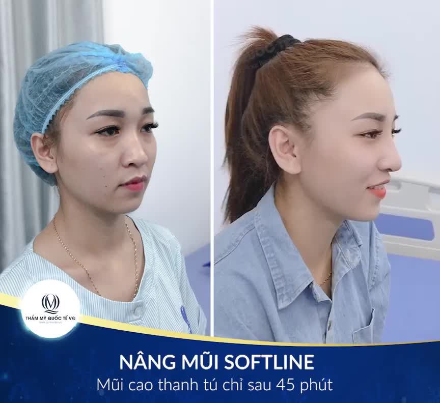 KẾT QUẢ NÂNG MŨI SOFTLINE SAU 9 NGÀY