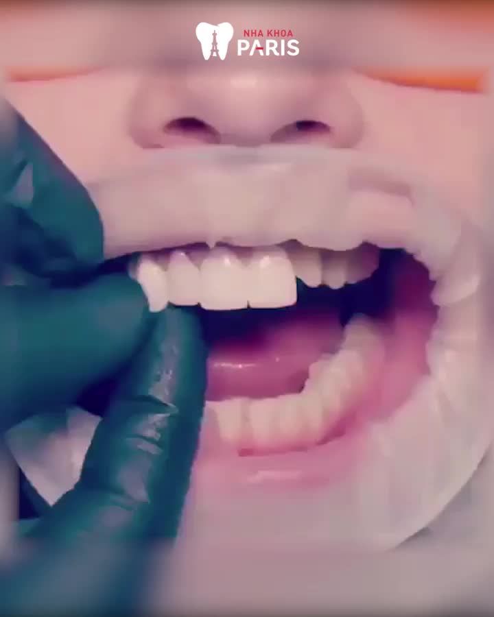 MỤC SỞ THỊ: Cận Cảnh Dán Sứ Veneer