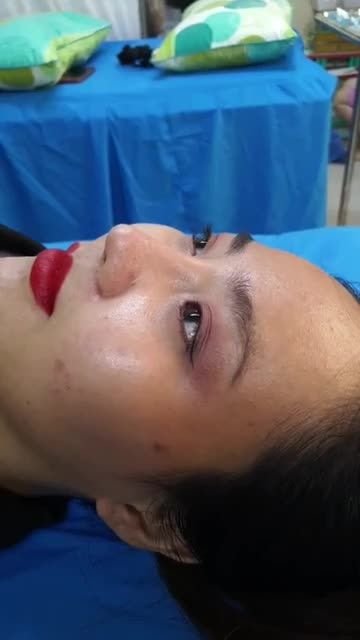 Nâng mũi bán cấu trúc 2 lớp
