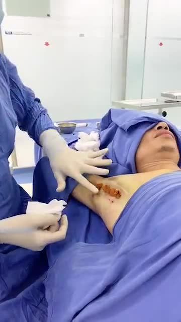 Hôi nách lâu năm Chữa mãi không khỏi