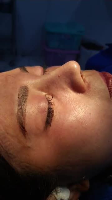 Nâng mũi bán cấu trúc đa lớp