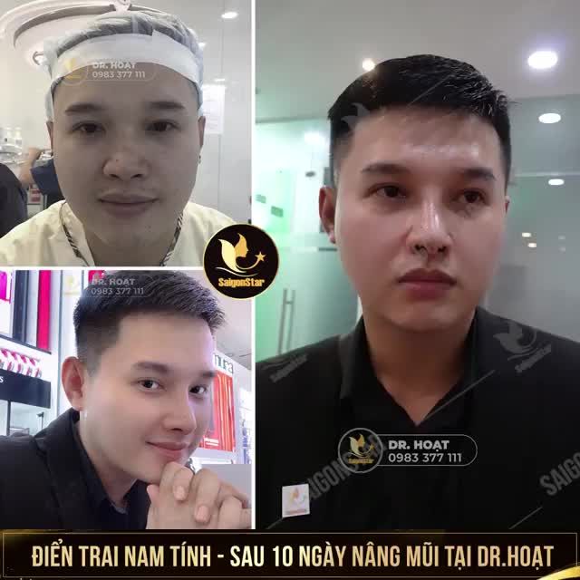 NÂNG MŨI CHO NAM GIỚI TẠI DR.HOẠT - LUÔN LÀM HÀI LÒNG PHÁI MẠNH