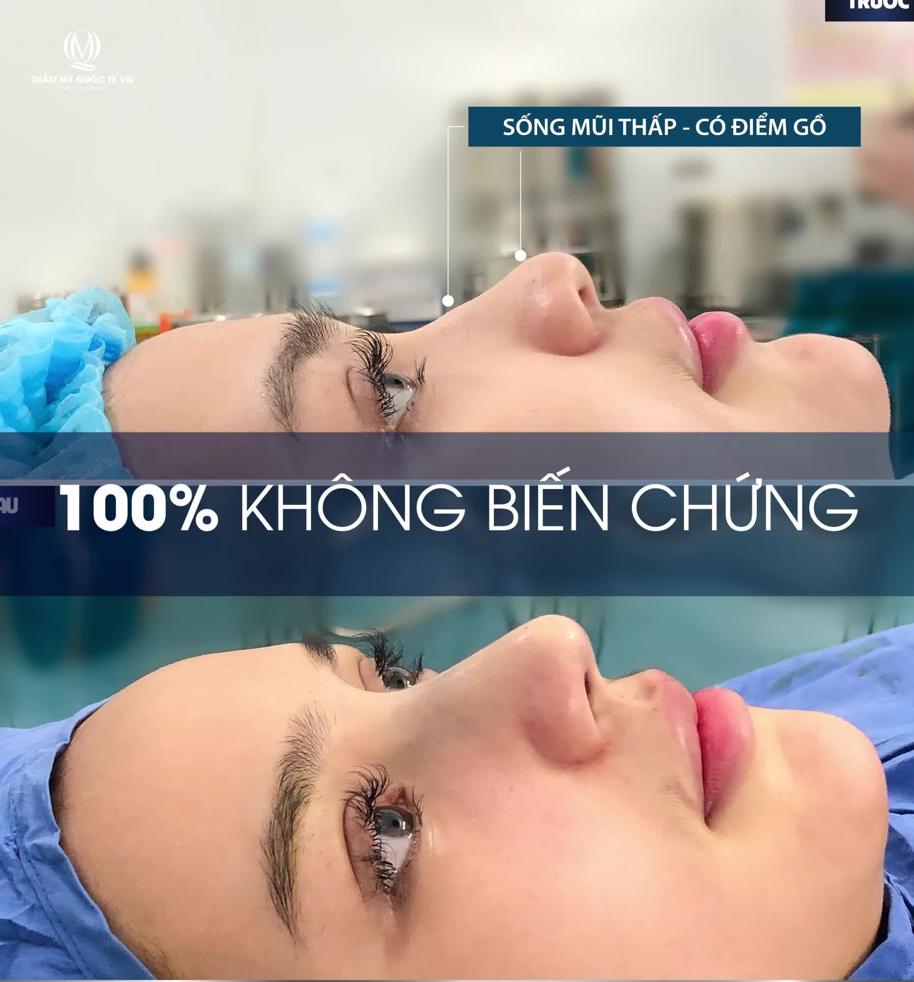 NÂNG MŨI SOFTLINE KẾT HỢP CÔNG NGHỆ PLASMA