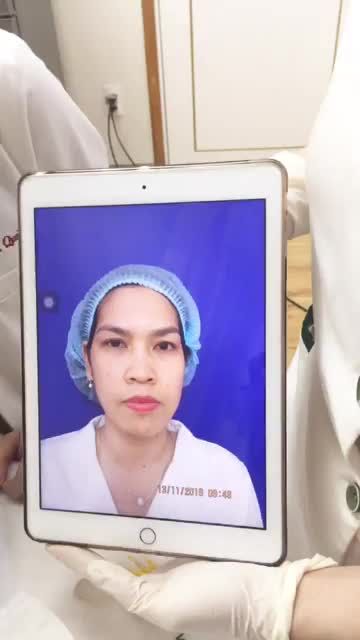 Hết sạch nám sau liệu trình điều trị tại thẩm mỹ viện Đông Á