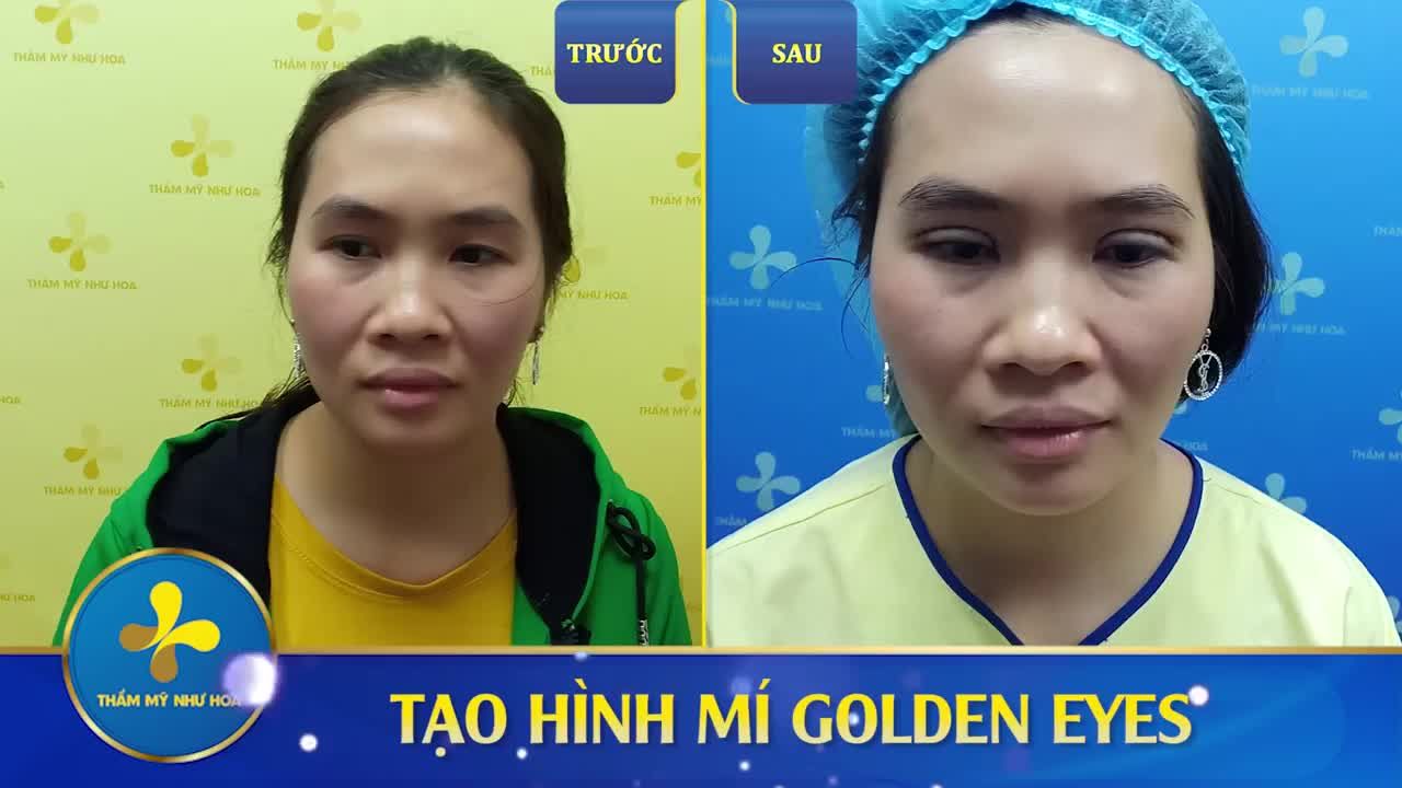 CẮT MÍ GOLDEN EYES - KẾT QUẢ NGAY SAU LÀM