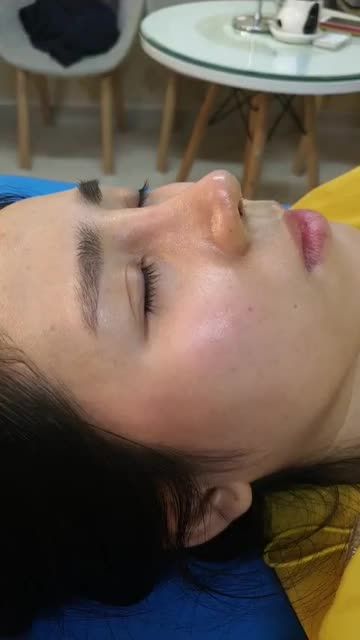 Nâng mũi bán cấu trúc 2 lớp