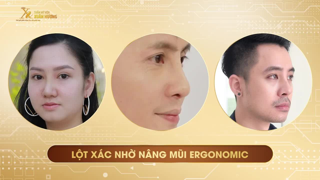TOP 3 CA "LỘT XÁC" NHỜ NÂNG MŨI ERGONOMIC TẠI TMV XUÂN HƯƠNG️