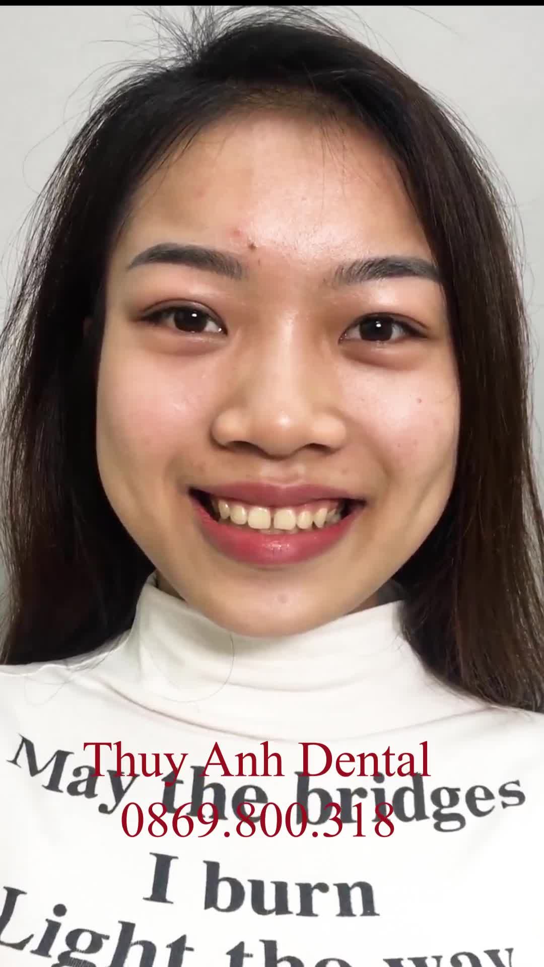 XINH ĐẸP HƠN VỚI MIẾNG DÁN SỨ VENEER TẠI NHA KHOA THÙY ANH.