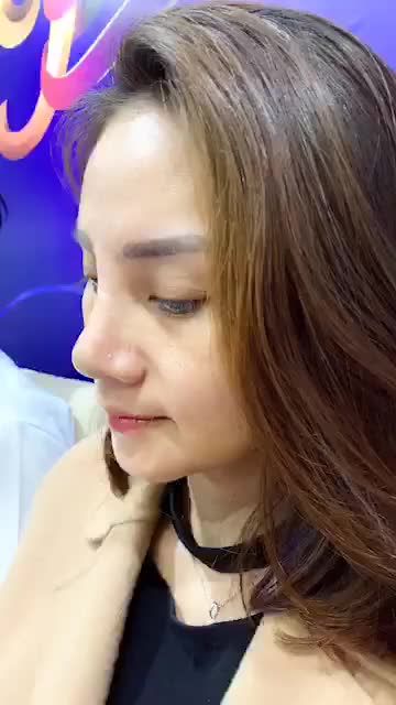 Bất ngờ với kết quả NÂNG MŨI CẤU TRÚC 4D + kết hợp chỉnh xương sau 7 ngày tại Bệnh viện thẩm mỹ Kangnam Hà Nội