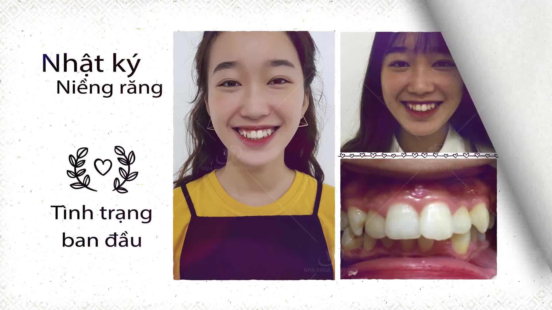 HÀNH TRÌNH GHI DẤU ẤN RIÊNG - NỤ CƯỜI TỎA SÁNG SAU NIỀNG RĂNG
